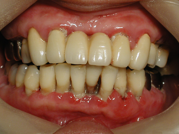 歯周病（歯槽膿漏）とは