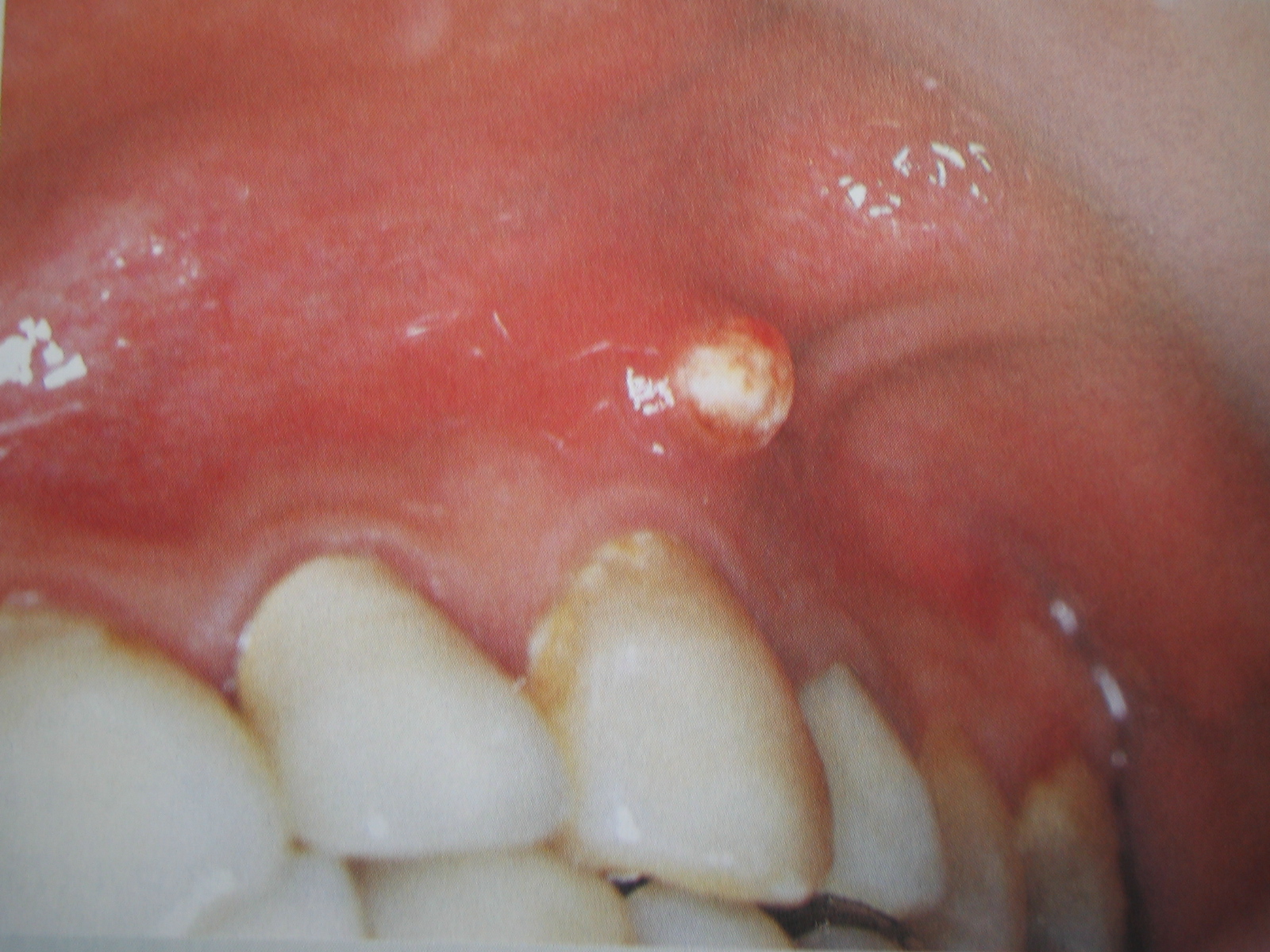 画像 : 口内炎？実は癌かも 舌にできる癌 舌癌 まとめ - NAVER まとめ